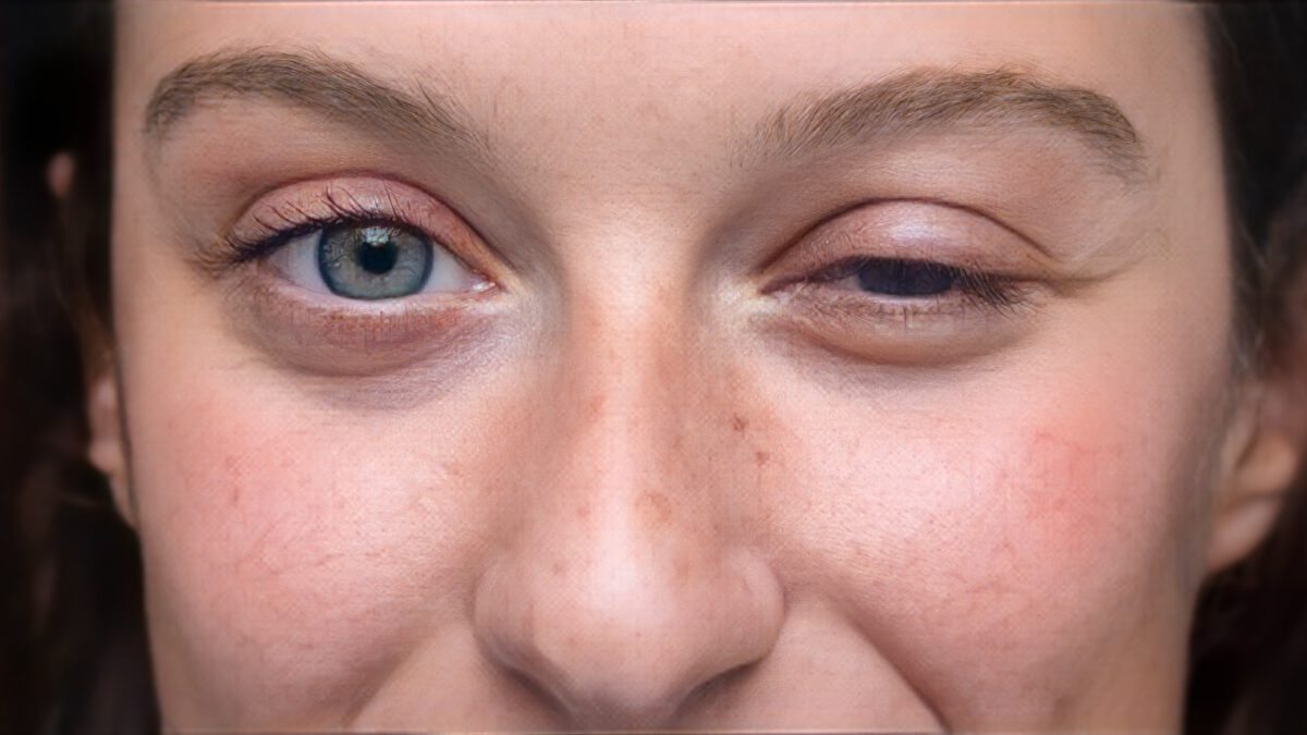 Myasthenia gravis – Augen