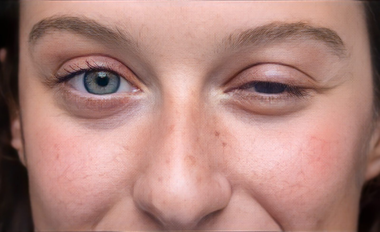 Myasthenia gravis – Augen