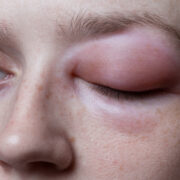 Young,Woman,With,Allergic,Reaction