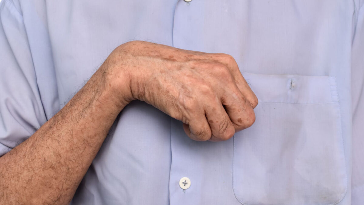 Nahaufnahme einer verkrampften Hand und eines angewinkelten Handgelenks als typisches Symptom einer Spastik.