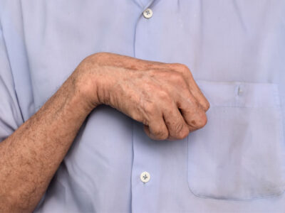 Nahaufnahme einer verkrampften Hand und eines angewinkelten Handgelenks als typisches Symptom einer Spastik.
