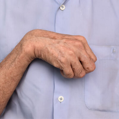 Nahaufnahme einer verkrampften Hand und eines angewinkelten Handgelenks als typisches Symptom einer Spastik.