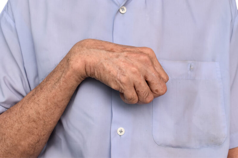 Nahaufnahme einer verkrampften Hand und eines angewinkelten Handgelenks als typisches Symptom einer Spastik.